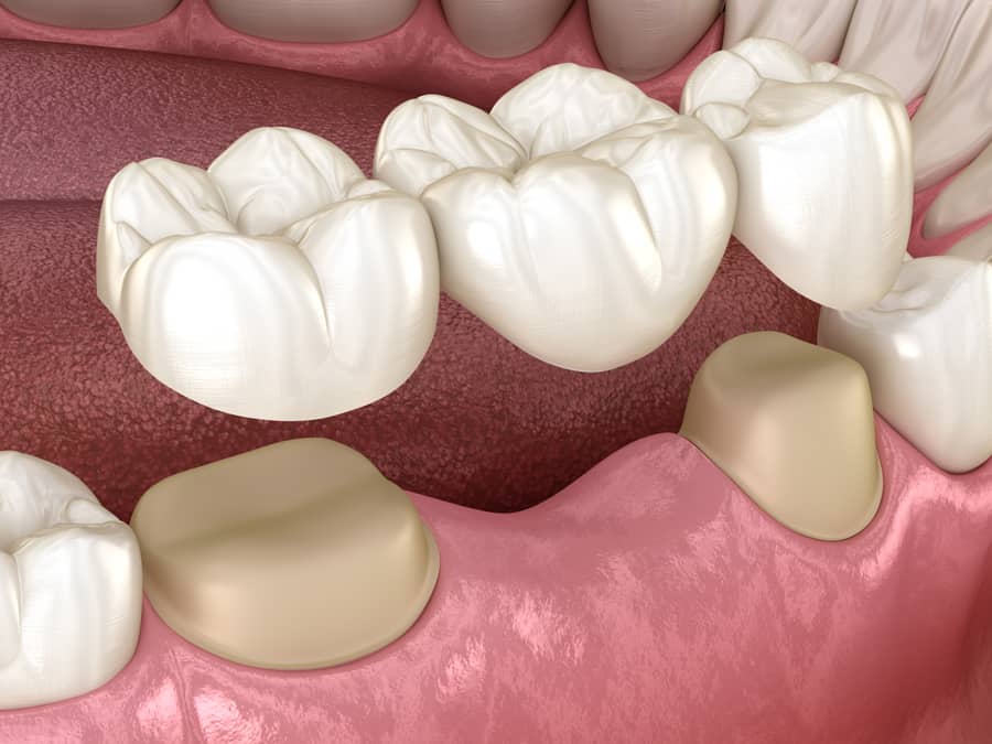 Tooth cap image
