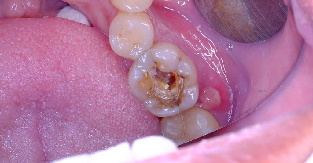 Cracked Tooth | Columbine Creek Dentistry