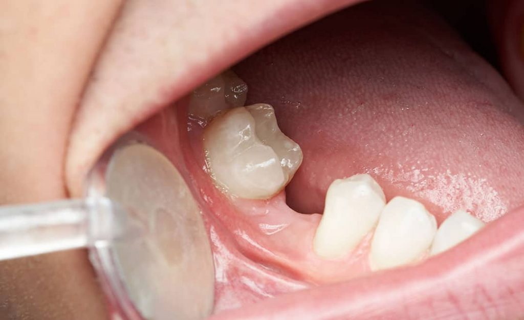 Missing Teeth | Columbine Creek Dentistry