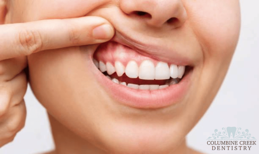 Gum Disease in Littleton