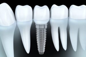 dental implant in littleton co columbine creek dentistry-dentist littleton