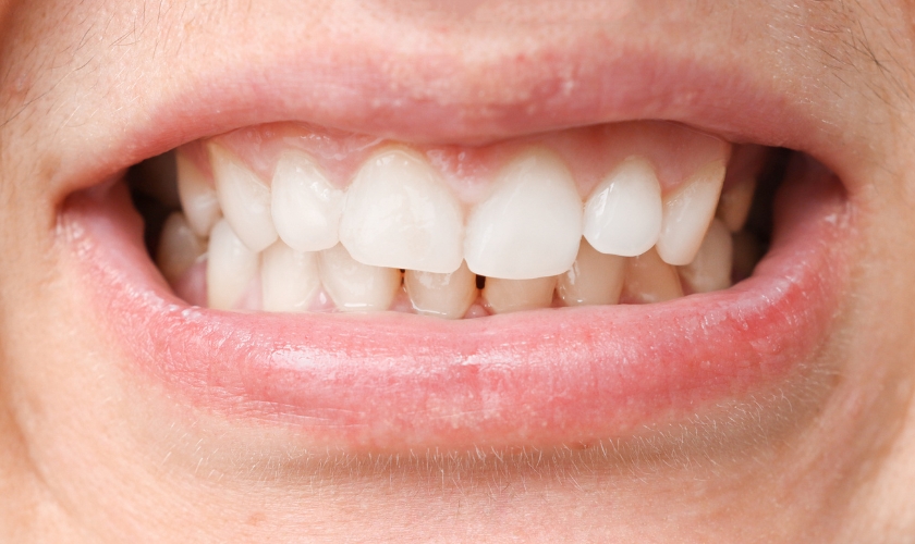 What is a crossbite_ Signs, effects and treatment