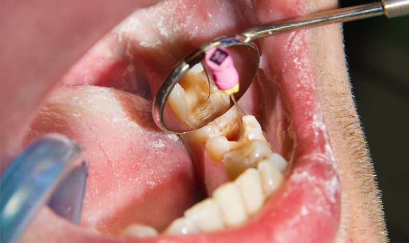 how long does a root canal treatment take to heal